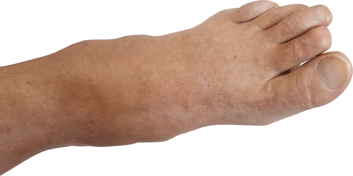 Charcot voet Charcot voet